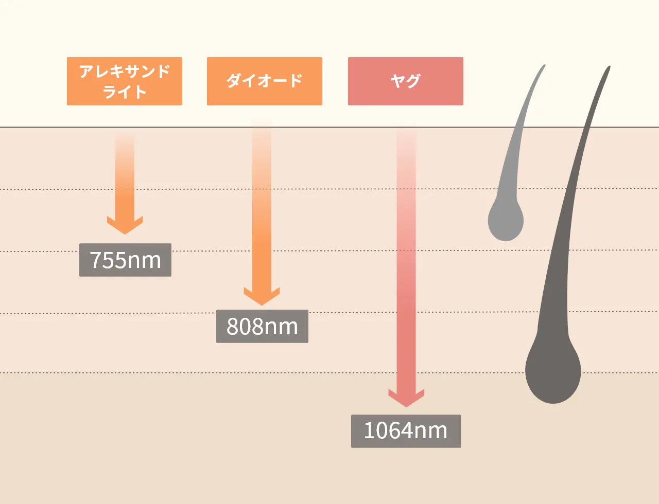 医療脱毛で使用される3種のレーザー